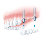 Implantologie Bild 2